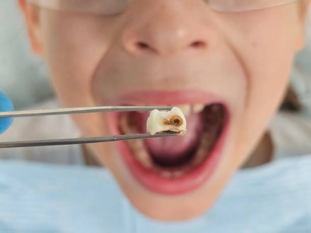 Best Knocked-Out Tooth (Avulsed Tooth) Treatment in Dorneyville, PA
